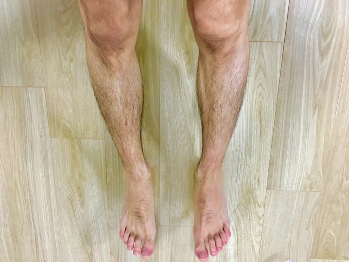 AGA治療の副作用　脚の体毛が増える