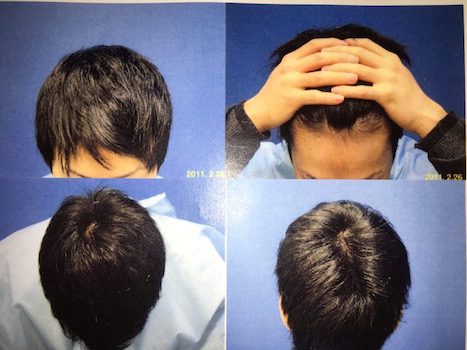 AGA治療から5か月経過後の頭皮